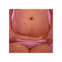 C-Section Silicone Scar Patches